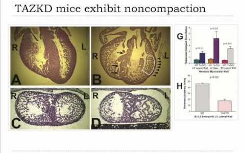 Developmental noncompaction cardiomyopathy in a mouse model of Barth syndrome