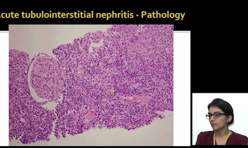 interstitial nephritis