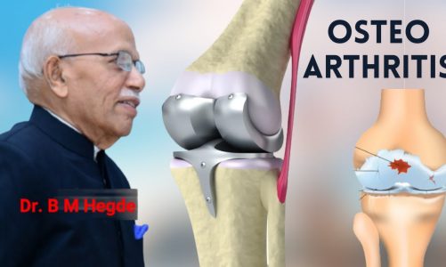 BEST TREATMENT For OSTEOARTHRITIS & Knee Replacement – Dr. B M Hegde