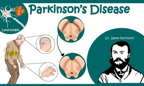 Parkinson's Disease (Shaking Palsy) |  Clinical Presentation & Pathophysiology of Parkinsons disease
