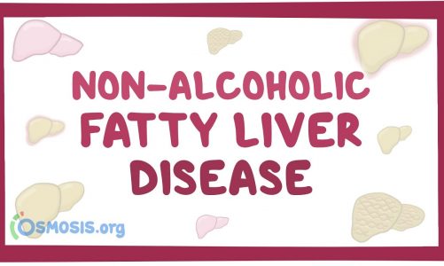 Non-alcoholic fatty liver disease- causes, symptoms, diagnosis, treatment, pathology
