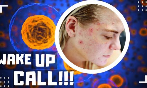 Mitochondria’s Role in Acne  ELIMINATE PIMPLES | Major Wake Up Call!!!