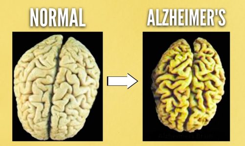 The BIGGEST  reason people get Alzheimer’s Disease (DEMENTIA)
